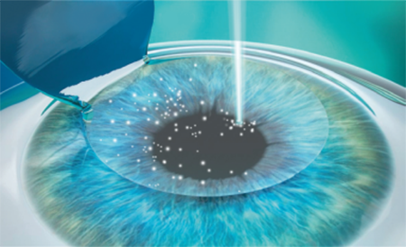 Laser Vision Correction